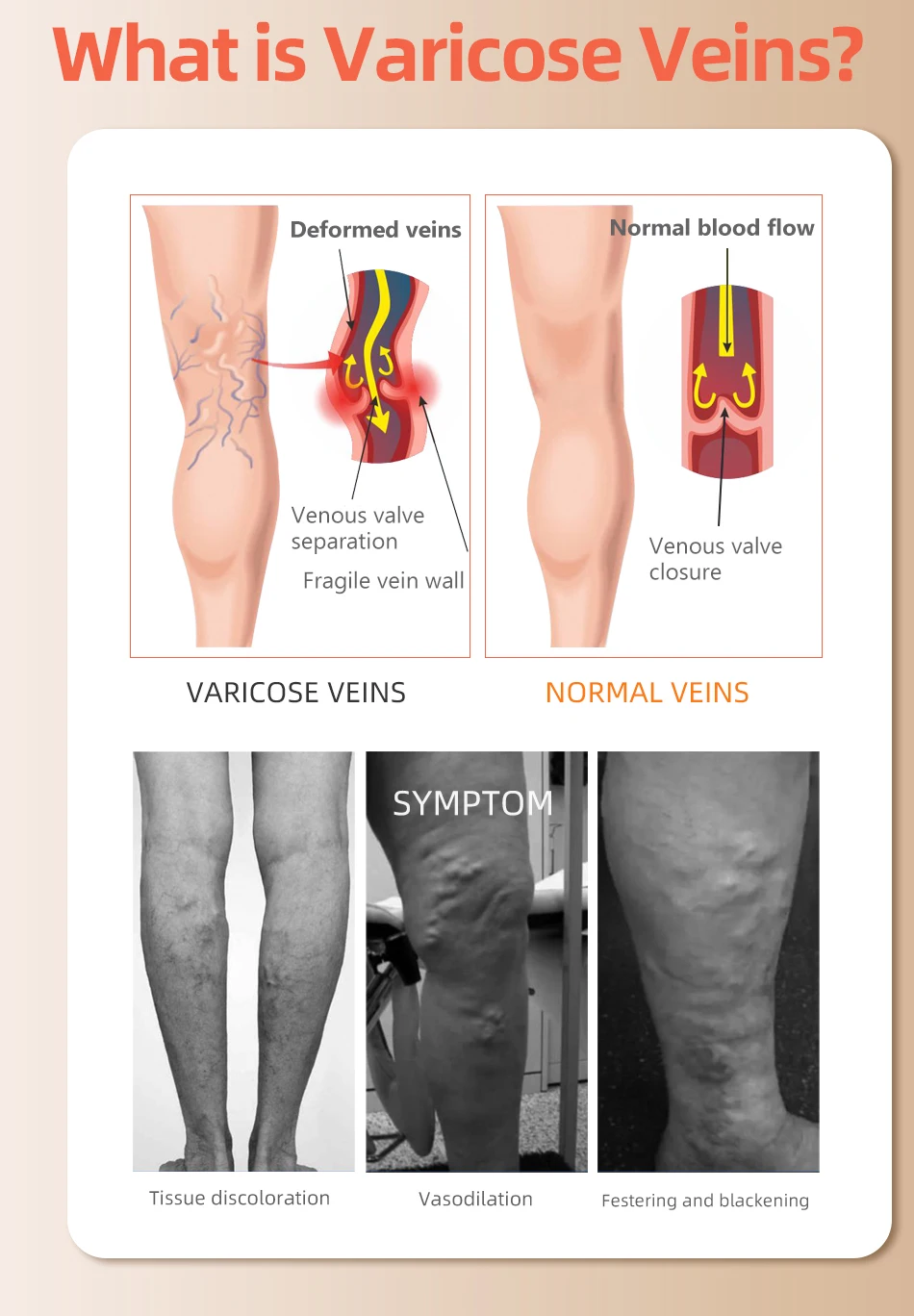 30-40 MmHg Diz Üstü Kapalı Aya - Compression Sock Medical incelemesi ve fiyatı